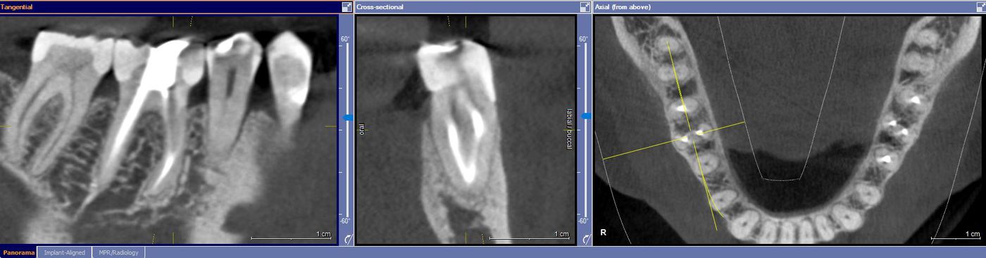 3D Image and Root Canal Procedure - Center 4 Smiles